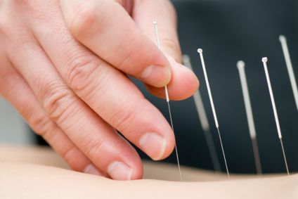 J’ai testé l’acupuncture