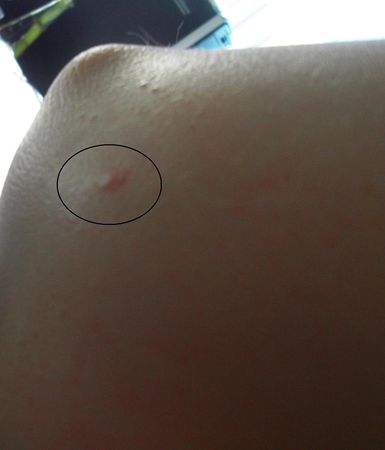 L’été c’est les moustiques, mais solutions bio existent :)